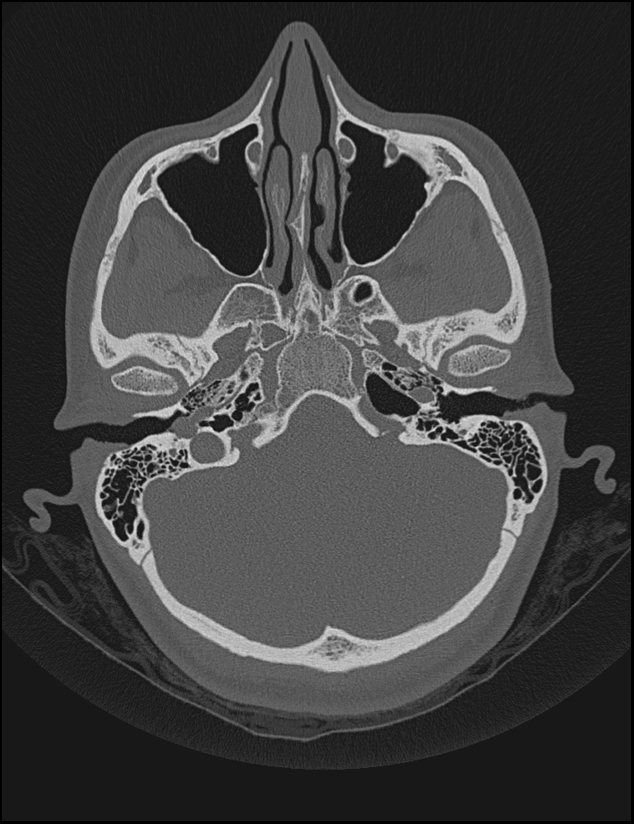 Aberrant right internal carotid artery (Radiopaedia 65191-74198 Axial non-contrast 34).jpg
