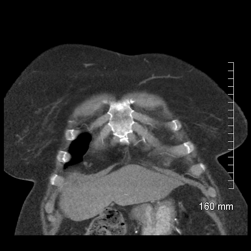 Aberrant right subclavian artery stenosis (Radiopaedia 52656-58670 B 18).jpg