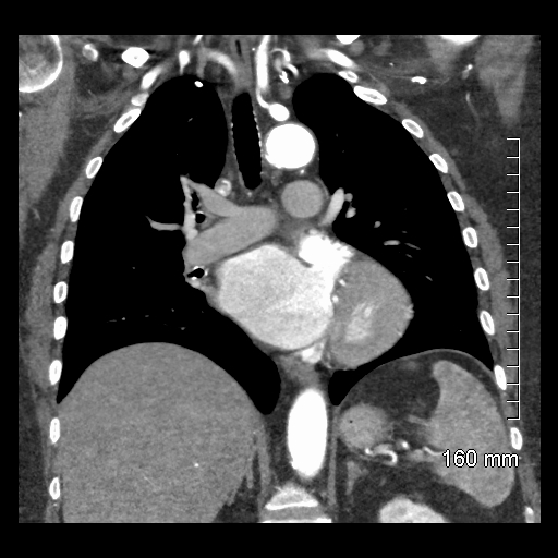 File:Aberrant right subclavian artery stenosis (Radiopaedia 52656-58670 B 49).jpg