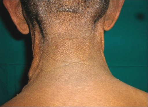 File:Acanthosis nigricans and plantar keratoderma in association with metastatic carcinoma of the bladder.png