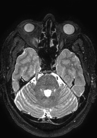 Accessory middle cerebral artery (Radiopaedia 73114-83828 Axial T2 149).jpg