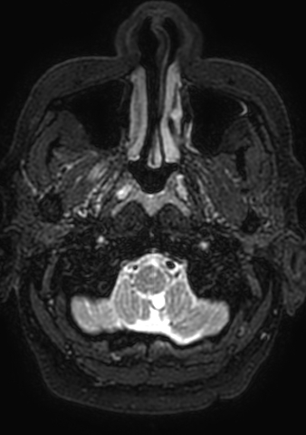 Accessory middle cerebral artery (Radiopaedia 73114-83828 Axial T2 215).jpg