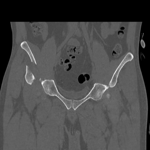 Acetabular and ilial fractures (Radiopaedia 59084-66378 Coronal bone window 18).jpg