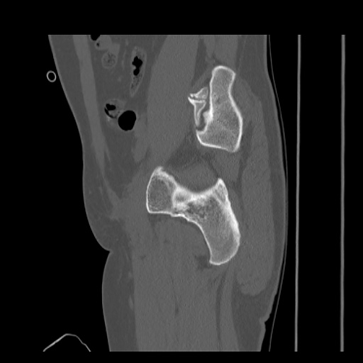 File:Acetabular and ilial fractures (Radiopaedia 59084-66378 Sagittal bone window 34).jpg