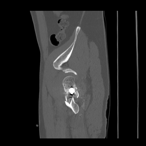 Acetabular and ilial fractures (Radiopaedia 59084-66378 Sagittal bone window 84).jpg