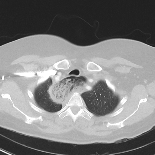 File:Achalasia (Radiopaedia 47147-51685 Axial lung window 9).png