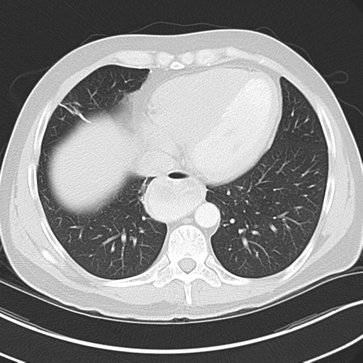 Achalasia of the cardia (Radiopaedia 38497-40595 Axial lung window 38).png