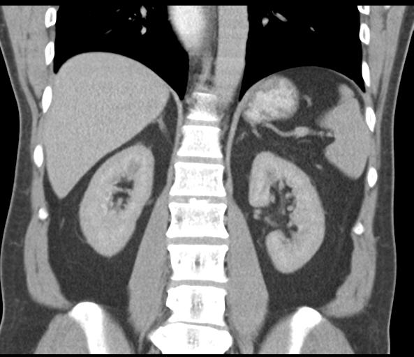 File:Achalasia of the cardia (Radiopaedia 38497-40595 Coronal C+ portal venous phase 35).png