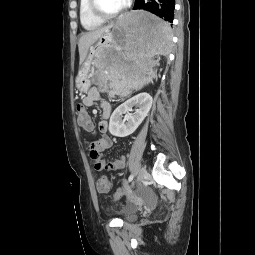 Acinar cell carcinoma of the pancreas (Radiopaedia 75442-86669 Sagittal C+ portal venous phase 122).jpg