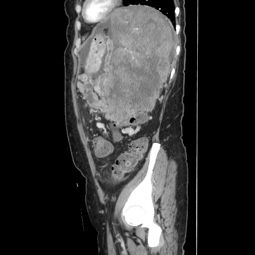 File:Acinar cell carcinoma of the pancreas (Radiopaedia 75442-86669 Sagittal C+ portal venous phase 143).jpg