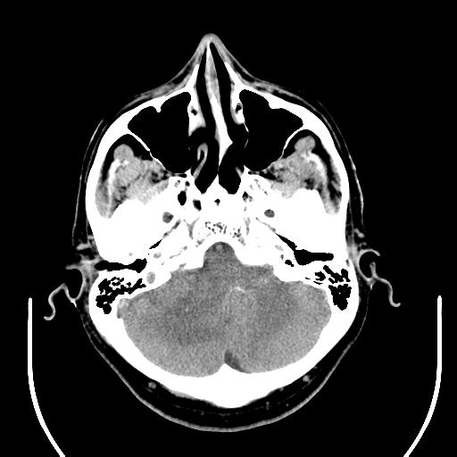 File:Acoustic schwannoma (Radiopaedia 29488-29982 AXIAL THICK non-contrast 10).jpg