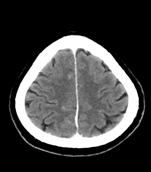 File:Acoustic schwannoma (Radiopaedia 33045-34065 Axial C+ delayed 23).png