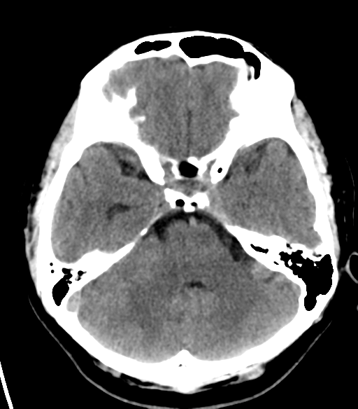 File:Acoustic schwannoma (Radiopaedia 33045-34065 Axial non-contrast 7).png