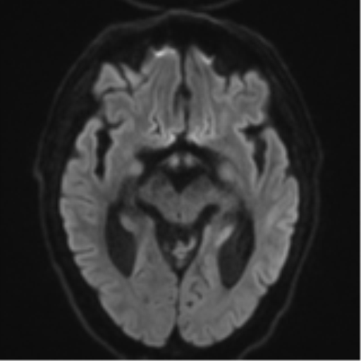 Acoustic schwannoma (Radiopaedia 55729-62281 E 38).png