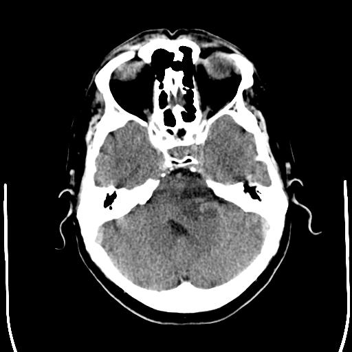 File:Acoustic schwannoma - cystic (Radiopaedia 29487-29980 AXIAL THICK non-contrast 8).jpg