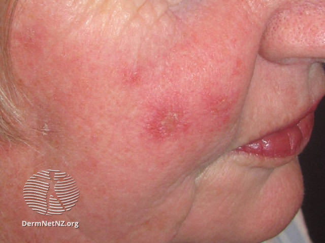 Actinic Keratoses treated with imiquimod (DermNet NZ lesions-ak-imiquimod-3722).jpg