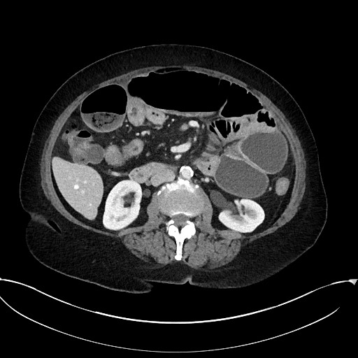 Active Crohn disease (Radiopaedia 59394-66750 Axial C+ portal venous phase 34).jpg