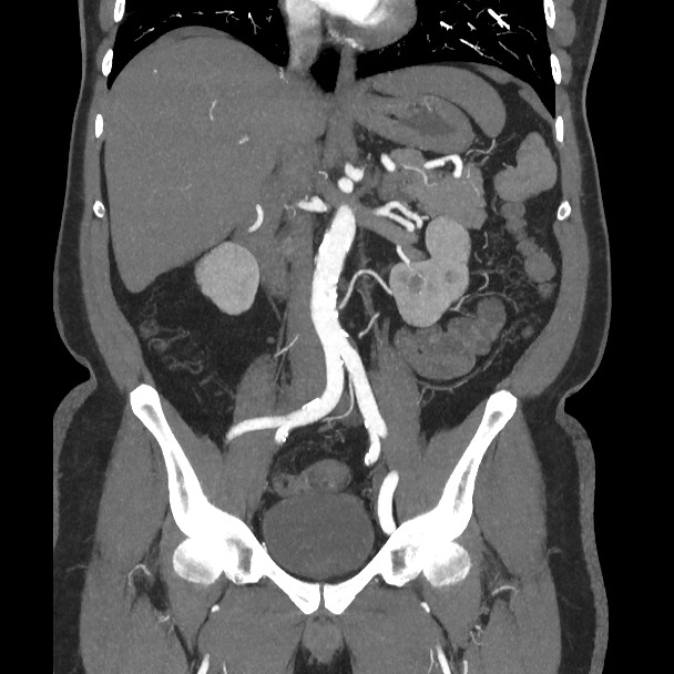 Active colonic bleed on CT (Radiopaedia 49765-55025 Coronal art MIP 34).jpg