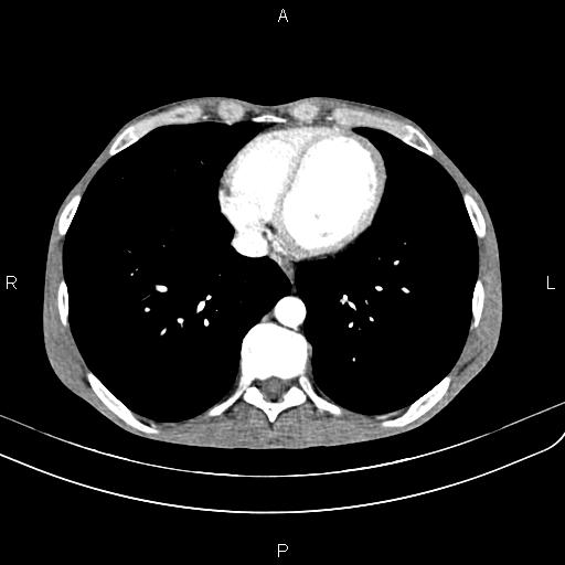 Active crohn disease (Radiopaedia 87133-103397 Axial C+ arterial phase 5).jpg