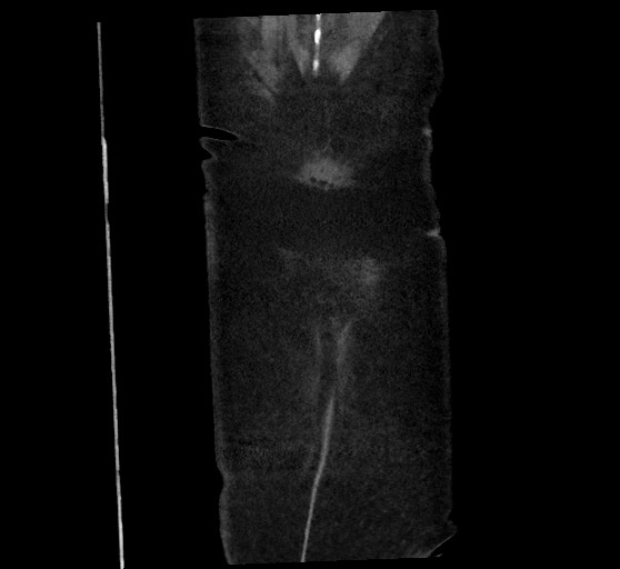 Active renal extravasation with large subcapsular and retroperitoneal hemorrhage (Radiopaedia 60975-68796 Coronal C+ arterial phase 145).jpg