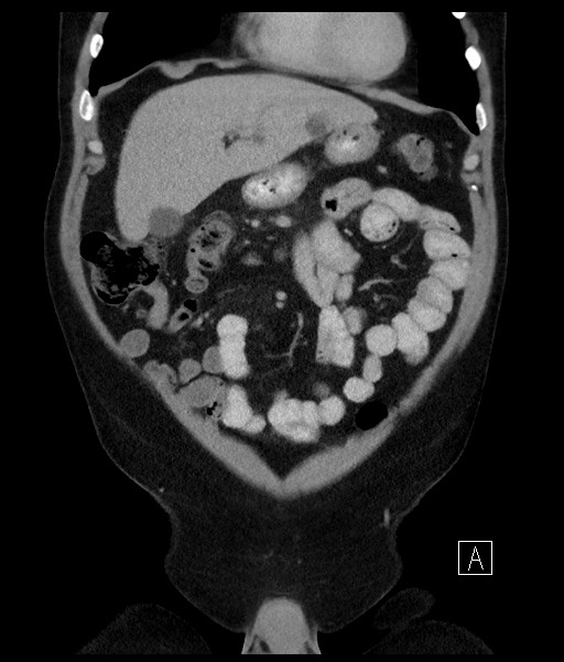 Acute-on-chronic pancreatitis (Radiopaedia 67286-76656 Coronal C+ portal venous phase 26).jpg