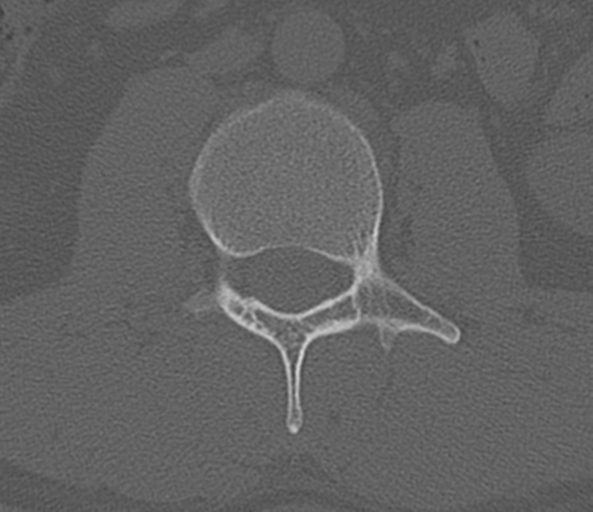File:Acute L1 burst compression fracture (Radiopaedia 34430-35755 Axial bone window 37).png