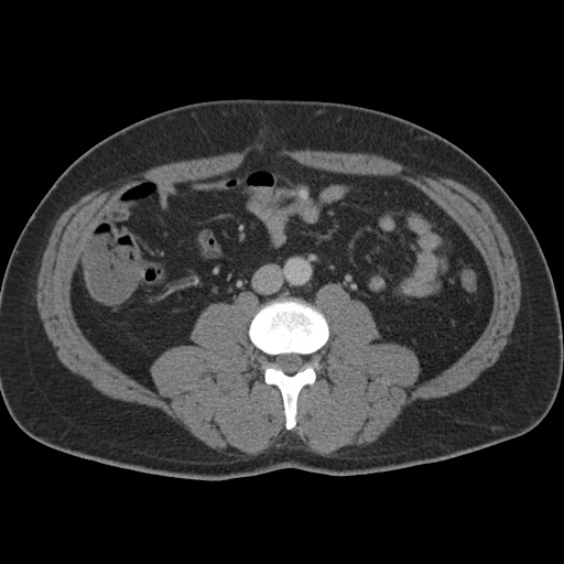 Acute appendicitis (Radiopaedia 48511-53463 Axial C+ portal venous phase 56).jpg