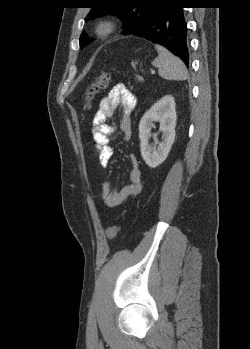 Acute appendicitis (Radiopaedia 48511-53463 Sagittal C+ portal venous phase 102).jpg