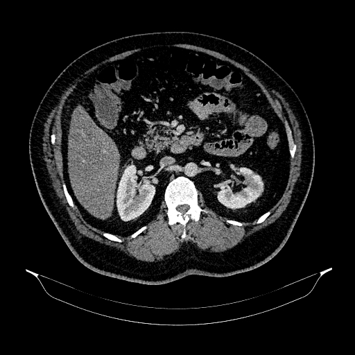 Acute appendicitis (Radiopaedia 79950-93224 Axial C+ portal venous phase 42).jpg
