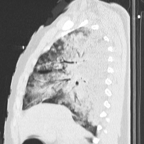 Acute aspiration pneumonitis (Radiopaedia 33605-34703 Sagittal lung window 34).jpg