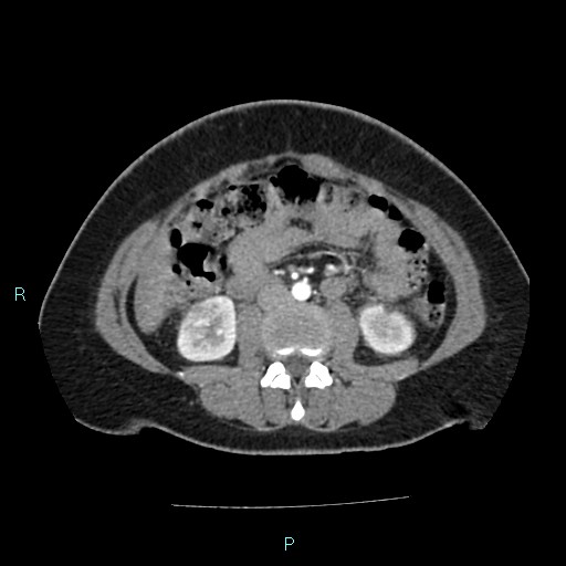File:Acute bilateral pyelonephritis (Radiopaedia 37146-38881 Axial C+ arterial phase 101).jpg