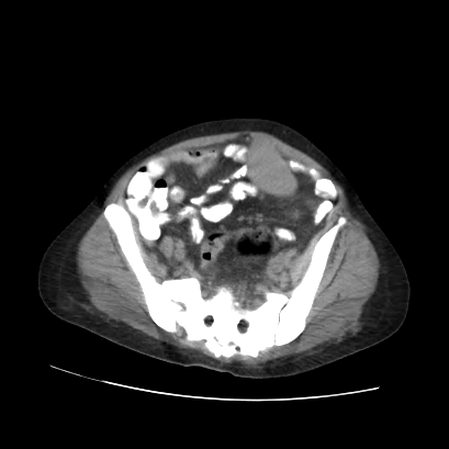 File:Acute calculous cholecystitis in patient with osteopetrosis (Radiopaedia 77871-90159 Axial non-contrast 63).jpg