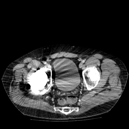 File:Acute cholecystitis and incidental left sided IVC (Radiopaedia 49352-54459 Axial C+ portal venous phase 141).jpg