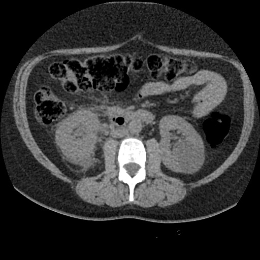 Acute cholecystitis and ureteric colic (Radiopaedia 42330-45444 Axial prone 47).jpg