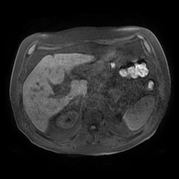 Acute cholecystitis complicated by pylephlebitis (Radiopaedia 65782-74915 Axial T1 fat sat 45).jpg