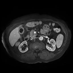 Acute cholecystitis complicated by pylephlebitis (Radiopaedia 65782-74915 Axial arterioportal phase T1 C+ fat sat 78).jpg