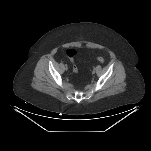 Acute cholecystitis with tensile fundus sign (Radiopaedia 71394-81723 Axial non-contrast 96).jpg