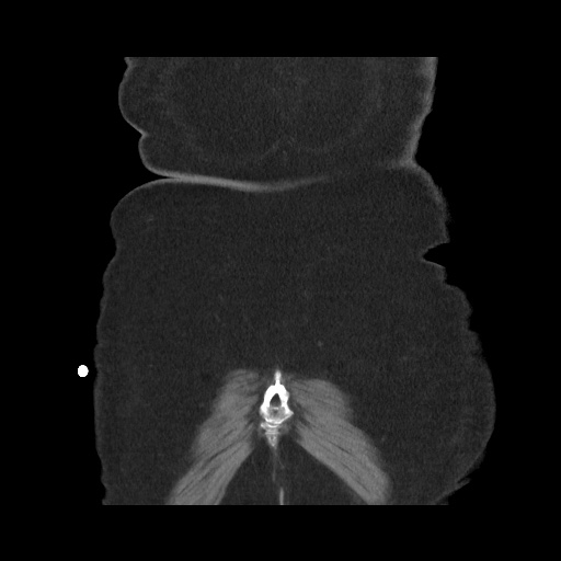 Acute cholecystitis with tensile fundus sign (Radiopaedia 71394-81723 Coronal non-contrast 117).jpg
