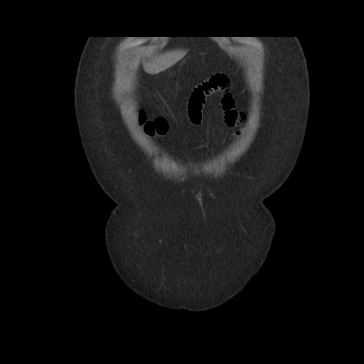 File:Acute cholecystitis with tensile fundus sign (Radiopaedia 71394-81723 Coronal non-contrast 24).jpg