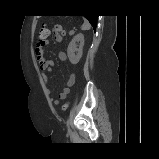 Acute cholecystitis with tensile fundus sign (Radiopaedia 71394-81723 Sagittal non-contrast 118).jpg