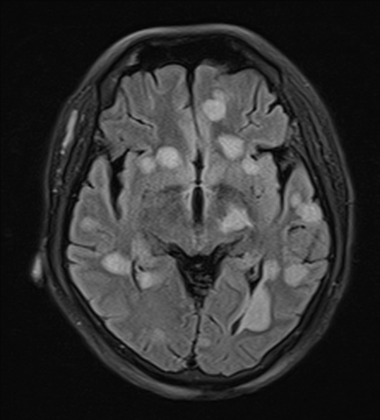 File:Acute disseminated encephalomyelitis (Radiopaedia 37253-39033 Axial FLAIR 13).jpg