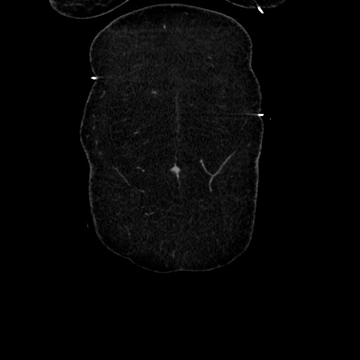 Acute diverticulitis - transverse colon (Radiopaedia 87063-103327 Coronal C+ portal venous phase 27).jpg