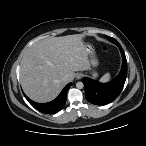 File:Acute diverticulitis with localized perforation (Radiopaedia 41296-44113 Axial C+ portal venous phase 16).jpg