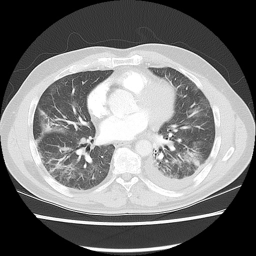 Acute epicardial fat necrosis (Radiopaedia 42327-45440 Axial lung window 35).jpg