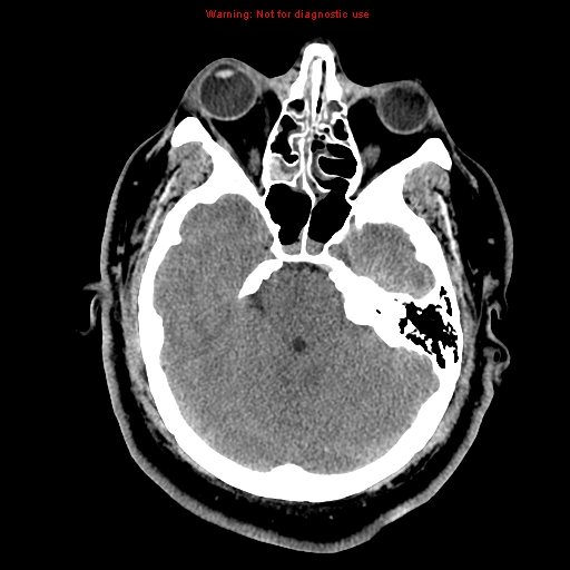 Acute hemorrhagic leukoencephalitis (Radiopaedia 14076-13920 Axial non-contrast 14).jpg