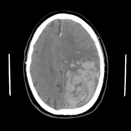 Acute hemorrhagic stroke (Radiopaedia 17507-17223 Axial non-contrast 36).jpg