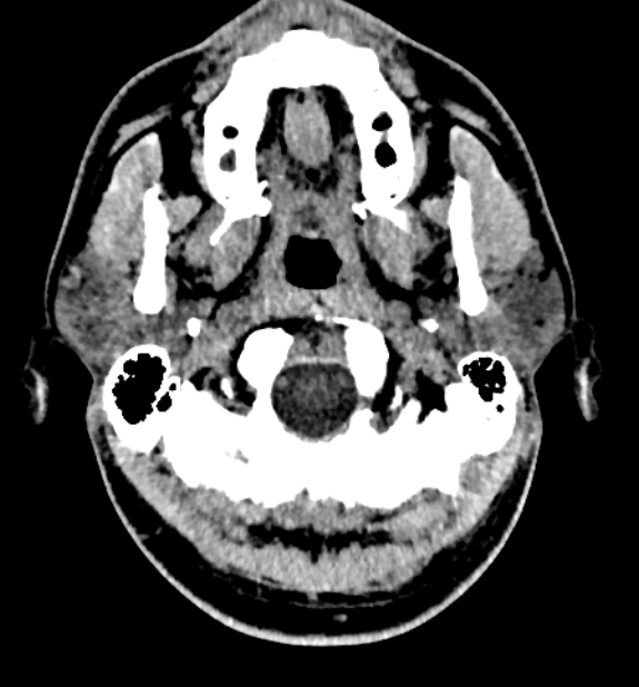 Acute ischemic stroke - posterior circulation territory (Radiopaedia 77670-89881 non-contrast 3).jpg