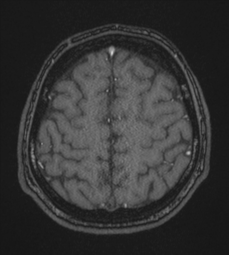 Acute left middle cerebral artery territory infarct with clot retrieval (Radiopaedia 47732-52433 Axial MRA 55).png