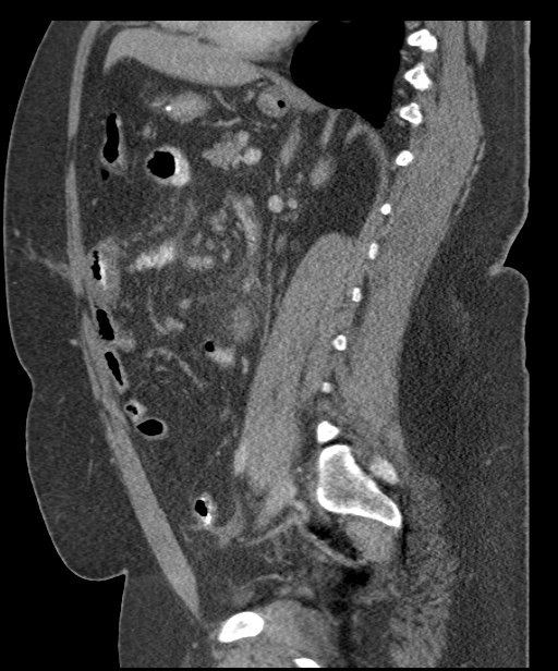Acute mesenteric venous ischemia (Radiopaedia 46041-50383 Sagittal C+ portal venous phase 70).jpg