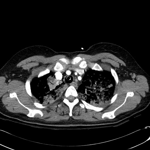 Acute myocardial infarction in CT (Radiopaedia 39947-42415 Axial C+ arterial phase 26).jpg